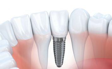 Dental Implants – Fundamentals & Prices
